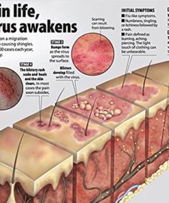 Shingles Treatment Cream - Best Nerve Pain Relief - Formulated For Shingles R.. 12 57 0c467104 8937 4d4e ba2b 157232416edb