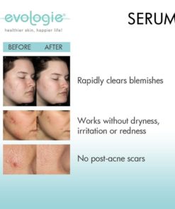 Evologie Intensive Blemish Serum | Best Serum To Rapidly Reduce Blemishes/Pim.. 6 57 2dc000b9 e340 4f97 8173 f07669d1442d