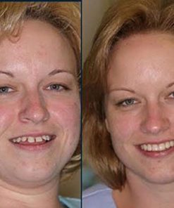 Alternative view of Imako Cosmetic Upper Teeth Temporary Smile Overlay (Large Natural)