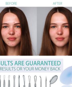 Blackhead And Pimple Remover Kit - Professional Instructions Included - 7 Sur.. 15 57 83c7653f a282 4d12 a6d4 dfc44f04ef3a