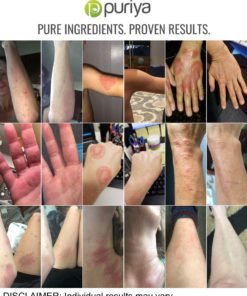 Puriya Cream for Eczema, Psoriasis, Dermatitis and Rashes. Powerful Plant Rich Formula Provides Instant and Lasting Relief for Severely Dry, Cracked, or Irritated Skin (4.5 oz) Light Peppermint 4.5 Ounce 12 71JrZE18xfL