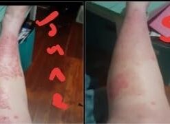 MG217 Multi Symptom Relief 2% Coal Tar Medicated Psoriasis Ointment oz Jar, 4 Oz 4 Ounce (Pack of 1) 36 31H1vkXoN9L