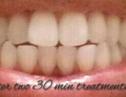 Opalescence 35% Gel Syringes Teeth Whitening - Refill Kit (4 Packs / 8 Count) Carbamide Peroxide. Made by Ultradent, in Cool Mint Flavor. Tooth Whitening Refill Syringes 5197-4 Mint 35 8 Count (Pack of 1) 25 31XgoAj3OzL