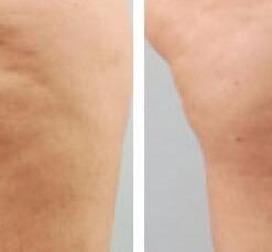 WeightLoss-Solutions Lipo-Boost Cellulite Cream with Caffeine is an Advanced Firming Lotion for Thighs and Butt, Stomach, Belly, Breasts, and Arms, to Smooth, Firm, Tone, and Tighten 21 31uj8ni2IgL