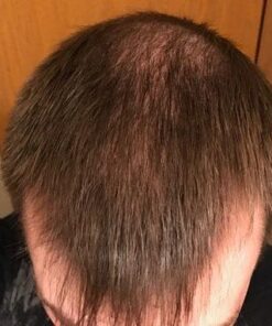 Men's Rogaine 5% Minoxidil Foam for Hair Loss and Hair Regrowth, Topical Treatment for Thinning Hair, 3-Month Supply, 2.11 Ounce (Pack of 3) Men's Rogaine Foam Treatment (3-Month Supply) 2.11 Ounce (Pack of 3) 45 41 i4V2TD3L