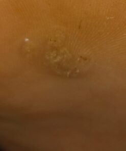 Compound W Maximum Strength One Step Plantar Wart Remover Foot Pads, 20 Count 20 Count (Pack of 1) 45 419t1K8392L