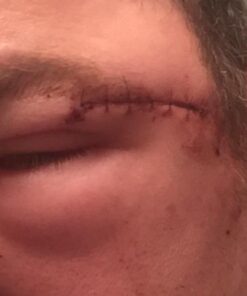 NewGel+E Advanced Silicone Scar Treatment Gel for OLD and NEW Scars w Vitamin E, for Surgery, Injury, Keloids, Burns, and Facial Blemish Scars (1 oz) 1 Ounce 22 41oEWDQxiLL