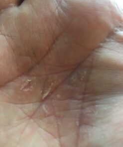 MG217 Multi Symptom Relief 2% Coal Tar Medicated Psoriasis Ointment oz Jar, 4 Oz 4 Ounce (Pack of 1) 39 41qf6qA7BUL