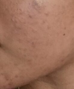 Glycolic Acid 50% Gel Peel with Chamomile and Green Tea Extracts - Professional Grade Chemical Face Peel for Acne Blemishes, Collagen Boost, Wrinkles, Fine Lines - Alpha Hydroxy Acid - 1 Bottle of 1 fl oz 43 513dErFprWL