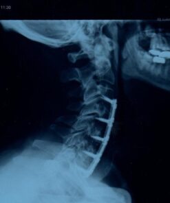 iReliev TENS + EMS Combination Unit Muscle Stimulator for Pain Relief & Arthritis & Muscle Strength - Treats Tired and Sore Muscles in Your Shoulders, Back, Ab's, Legs, Knee's and More 31 518AtMz7COL