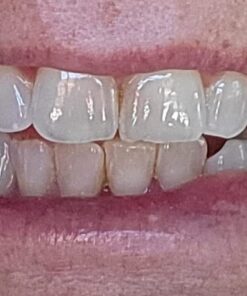 Opalescence 35% Gel Syringes Teeth Whitening - Refill Kit (2 Packs / 4 Count) Carbamide Peroxide. Made by Ultradent, in Cool Mint Flavor. Tooth Whitening Refill Syringes 5197-2 Mint 35 4 Count (Pack of 1) 40 51AXxnWO6 L