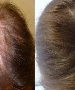 Newopure: Natural Hair Growth Vitamins, Repairs Hair Follicles, Stops Hair Loss, Blocks DHT, Stimulates New Hair Growth, Promotes Thicker, Fuller and Faster Growing Hair. Men & Women (30 Day Supply) 29 51E79oKgtvL