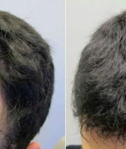 PRN Pure Results Nutrition DasGro Hair Growth Vitamins, Biotin & DHT Blocker, Stops Hair Loss, Thinning, Balding, Promotes Hair Regrowth in Men & Women, All Hair Types, 30 Day Supply 22 51G66 lwf2L 1