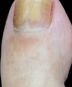 emuaid EMUAIDMAX Ointment 2oz - Eczema Cream. Maximum Strength Treatment. Use Max Strength for Athletes Foot, Psoriasis, Jock Itch, Anti Itch, Rash and Skin Yeast Infection. Standard Packaging 31 51RBfbb2jQL