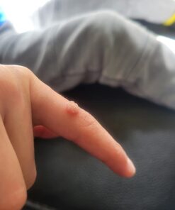 Compound W One Step Wart Remover Strips for Kids, 10 Medicated Strips for Wart Removal, 2 Pack unflavored 10 Count (Pack of 2) 44 51RRzBQgxGL