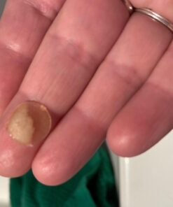 Nexcare Acne Cover, Skin Cover Absorbs Pus and Oil From Clogged Pores, Suitable Skincare for Most Skin Types - 36 Acne Covers 36 Count (Pack of 1) 46 51Y6IMsGb9L