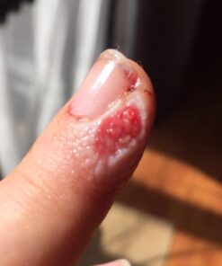 BerbereX Antimicrobial Wound Cleanser for Cuts, Scrapes, Burns, Incisions, Piercing Aftercare, Wounds, Wound Care, First Aid Antiseptic Antibacterial Spray, Pressure Sore, Diabetic Ulcer - 4oz 15 51asjfKCuL