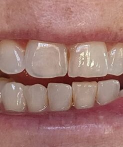 Opalescence 35% Gel Syringes Teeth Whitening - Refill Kit (2 Packs / 4 Count) Carbamide Peroxide. Made by Ultradent, in Cool Mint Flavor. Tooth Whitening Refill Syringes 5197-2 Mint 35 4 Count (Pack of 1) 41 51eo39P4rL