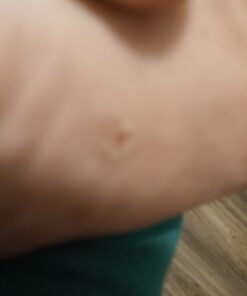 Compound W Freeze Off Advanced Wart Remover with Accu-Freeze, Multicolor, 1 Count 40 51fDAeUEdkL