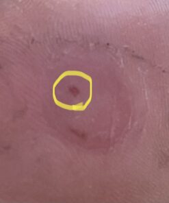 Compound W Wart Remover Maximum Strength One Step Pads, 14 Medicated Pads 14 Count (Pack of 1) 56 51i22bg9qIL