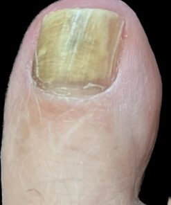 emuaid EMUAIDMAX Ointment 2oz - Eczema Cream. Maximum Strength Treatment. Use Max Strength for Athletes Foot, Psoriasis, Jock Itch, Anti Itch, Rash and Skin Yeast Infection. Standard Packaging 32 51mLcwOPoML