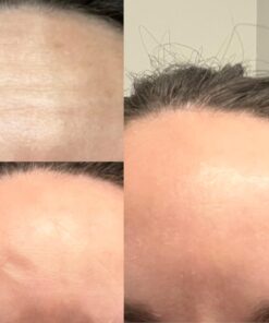 Frownies Forehead and Between Eyes Wrinkle Patches The Original Wrinkle Patch Non Invasive Wrinkle Smoothers for Forehead Wrinkles 37 61 Rd0VNsHL