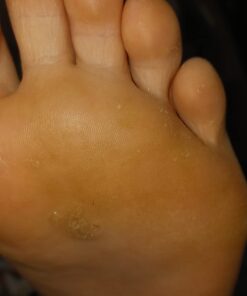 Compound W Maximum Strength One Step Plantar Wart Remover Foot Pads, 20 Count 20 Count (Pack of 1) 47 610 gmb4e7L