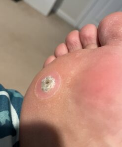 Dr. Scholl's Dual Action Freeze Away WART Remover, 8 Applications // Freeze Therapy + Powerful Fast Acting Salicylic Liquid to Remove Common and Plantar Warts, 0.33 Fl Oz, 1 Count 53 611o1InN0EL