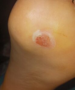 Compound W Maximum Strength One Step Plantar Wart Remover Foot Pads, 20 Count 20 Count (Pack of 1) 46 611o2EFtCL