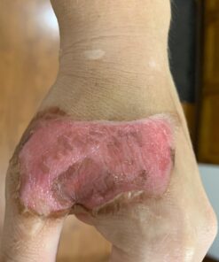 Terrasil Wound Care - 3X Faster Healing, Infection Protection for Bed sores, Pressure sores, Diabetic Wounds, Foot, Leg ulcers, cuts, scrapes, Burns - 50gm Tube 28 6125QqLS9GL