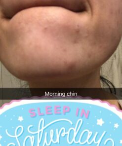 Ebanel Acne Drying Lotion, Overnight Salicylic Acid and Sulfur Cystic Acne Spot Treatment for Face and Body, Pimple Cream Spot Treatment, Dries Out Pimples, Cysts, Blemishes, Zits, and Clogged Pores 30 6126lURNixL