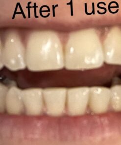 Remineralization Gel - 5 Syringes of Gel. Remineralizing and Reduces Teeth Sensitivity After Teeth Whitening Treatment 17 612Hhl09nL