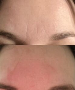 Frownies Forehead and Between Eyes Wrinkle Patches The Original Wrinkle Patch Non Invasive Wrinkle Smoothers for Forehead Wrinkles 49 614KsAxzyQL