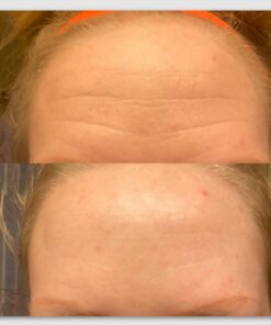 Facial Smoothies VARIETY Wrinkle Remover Strips, 160 anti wrinkle patches in 6 shapes 33 614bVkDEtL