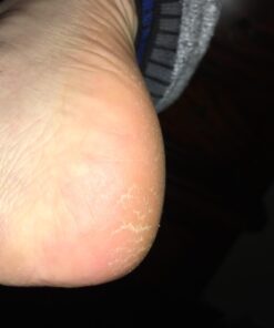 Amope Pedi Perfect Electronic Foot File, Dual-Speed Callus Remover (with Diamond Crystals) for Feet (Extra Coarse - Pink Gadget). -Perfect for In-home Pedicure for Baby Smooth Feet. Battery Operated 47 616i1BKLz2L