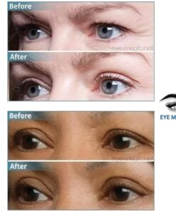 Eye Magic Original Eye Lift Kit (Small/Medium Size With Gel) Lifts Eyelid Droop and Hooded Eyes | Open And Show Off Your Beautiful Eyes | Made In America 14 6191FwjlV8L