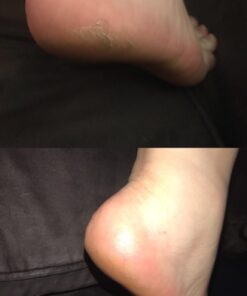 Amope Pedi Perfect Electronic Foot File, Dual-Speed Callus Remover (with Diamond Crystals) for Feet (Extra Coarse - Pink Gadget). -Perfect for In-home Pedicure for Baby Smooth Feet. Battery Operated 39 61AmPoRjvGL