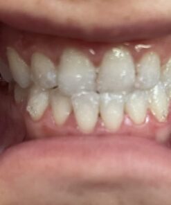 Opalescence 35% Gel Syringes Teeth Whitening - Refill Kit (2 Packs / 4 Count) Carbamide Peroxide. Made by Ultradent, in Cool Mint Flavor. Tooth Whitening Refill Syringes 5197-2 Mint 35 4 Count (Pack of 1) 33 61BCQJ9QtL