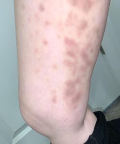 Scala Silicone Anti Cellulite Massager, Body Shower Scrubber, Cellulite Remover - Improve Circulation, Distribute Fat Deposits, Body Massager, Exfoliator, Fat Roller Use with Creams and Oils - Pink A. Pink 28 61C7XkFHdDL