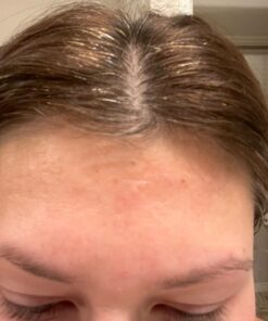 Frownies Forehead and Between Eyes Wrinkle Patches The Original Wrinkle Patch Non Invasive Wrinkle Smoothers for Forehead Wrinkles 40 61CGsKddEYL