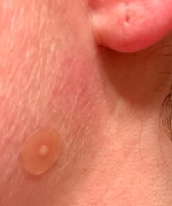 Nexcare Acne Cover, Skin Cover Absorbs Pus and Oil From Clogged Pores, Suitable Skincare for Most Skin Types - 36 Acne Covers 36 Count (Pack of 1) 48 61CVoNV91NL