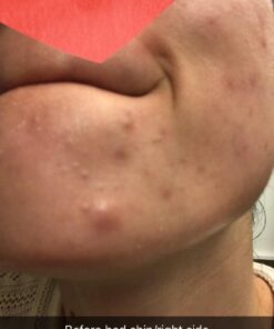 Ebanel Acne Drying Lotion, Overnight Salicylic Acid and Sulfur Cystic Acne Spot Treatment for Face and Body, Pimple Cream Spot Treatment, Dries Out Pimples, Cysts, Blemishes, Zits, and Clogged Pores 31 61CbtRXPcqL