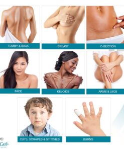 NewGel+E Advanced Silicone Scar Treatment Gel for OLD and NEW Scars w Vitamin E, for Surgery, Injury, Keloids, Burns, and Facial Blemish Scars (1 oz) 1 Ounce 16 61EBsSdApKL