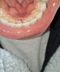 Opalescence 35% Gel Syringes Teeth Whitening - Refill Kit (2 Packs / 4 Count) Carbamide Peroxide. Made by Ultradent, in Cool Mint Flavor. Tooth Whitening Refill Syringes 5197-2 Mint 35 4 Count (Pack of 1) 32 61Eno KynkL