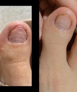 Toenail Renewal Solution Extra Strength Care for Toe Nail & Fingernails - Nail Repair Solution for Thick, broken, Discolored Nails - Renews Damaged Cracked Ingrown Toenail - Tea Tree Oil for Healthier and Extra Strength Nails - Made In USA 0.50 Fl Oz 47 61GWAK4hJHL