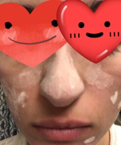 Ebanel Acne Drying Lotion, Overnight Salicylic Acid and Sulfur Cystic Acne Spot Treatment for Face and Body, Pimple Cream Spot Treatment, Dries Out Pimples, Cysts, Blemishes, Zits, and Clogged Pores 32 61IJofyajjL