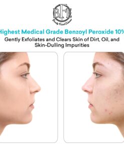 Beauty Facial Extreme Acne Gel Cleanser - 10% Benzoyl Peroxide, Fight Acne Blemishes on Contact for Cystic Breakouts, Oily Skin, Clogged Pores, Blackhead, Whitehead & Pimples. Achieve Clear Skin. 10 61IpUTiMdSL