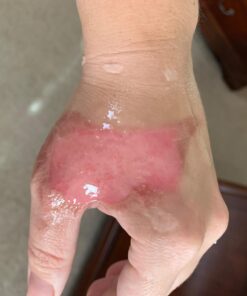 Terrasil Wound Care - 3X Faster Healing, Infection Protection for Bed sores, Pressure sores, Diabetic Wounds, Foot, Leg ulcers, cuts, scrapes, Burns - 50gm Tube 29 61JXTdFt3mL