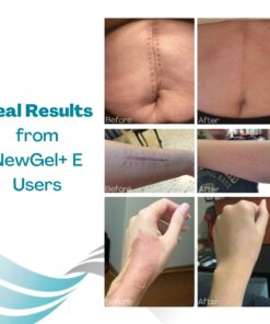 NewGel+E Advanced Silicone Scar Treatment Gel for OLD and NEW Scars w Vitamin E, for Surgery, Injury, Keloids, Burns, and Facial Blemish Scars (1 oz) 1 Ounce 19 61KEAed2TBL