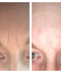 Facial Smoothies VARIETY Wrinkle Remover Strips, 160 anti wrinkle patches in 6 shapes 43 61NWzewXTOL